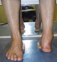 R&uuml;ckfu&szlig; Stumpf