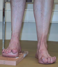 Krallenzehen und Druckstellen